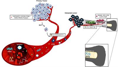 Current and Emerging Biomarkers Predicting Bone Metastasis Development